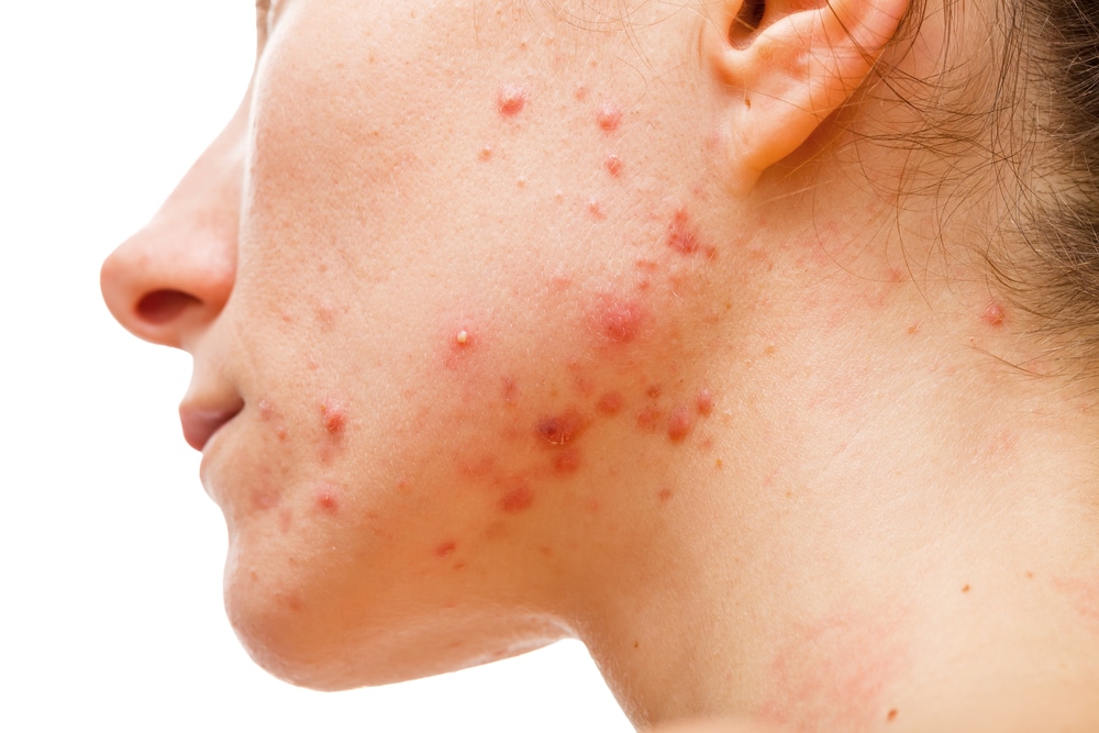 Acne Management in NYC 1 1780692974 4d66d9b94fc34865b9e4ee79ab157766 1