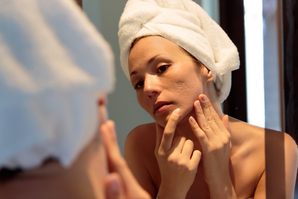 Subcision for Deep Acne Scars in NYC 1 1780693006 d71877c0c3b849c2ad09507c547c69a9 1